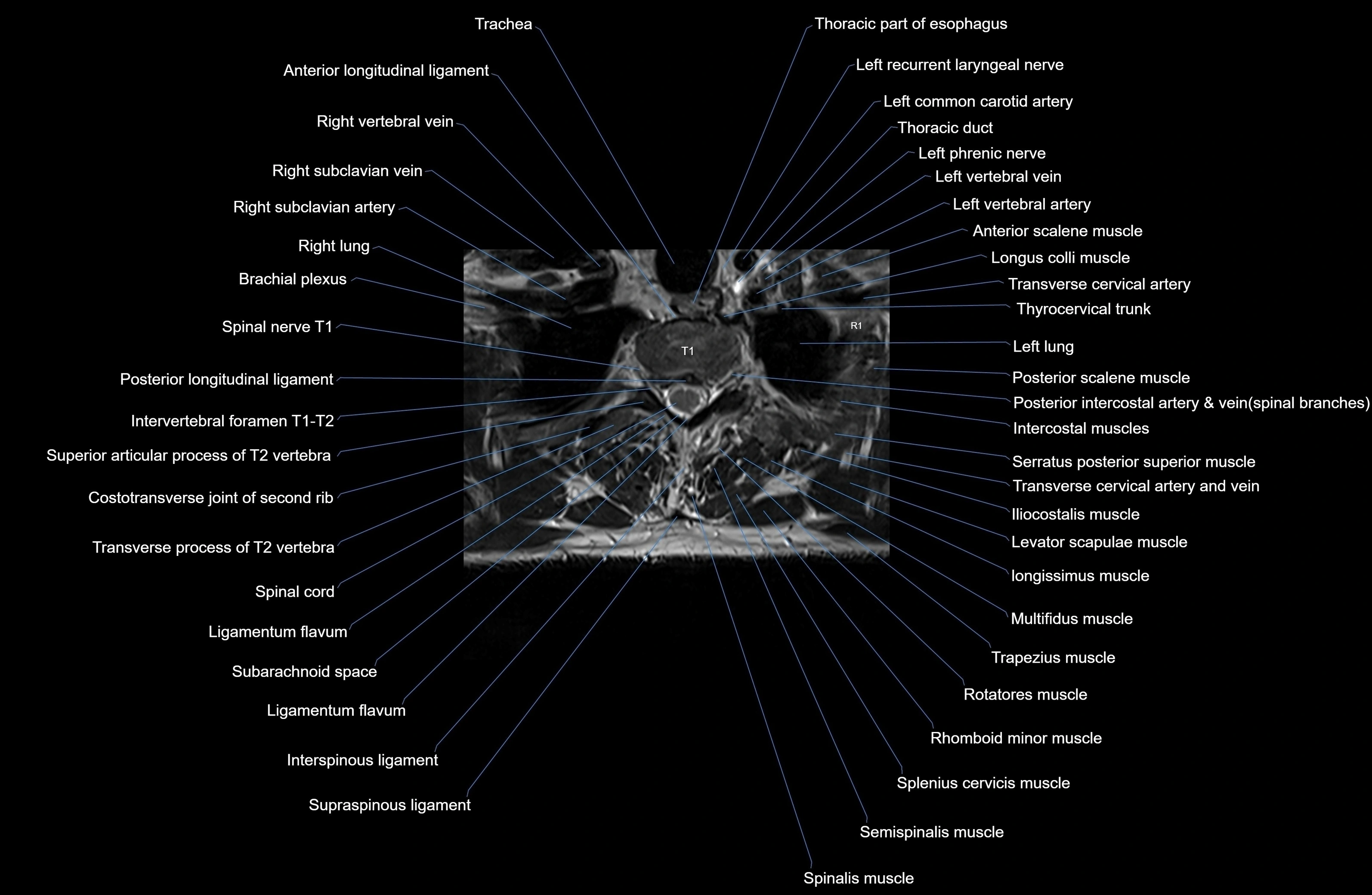MRI thoracic spine axial  cross sectional anatomy 3T radiology  image-img-00001-00011.webp